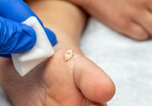 Healing treatment of cracked, dry wart, calluses on the child foot sole